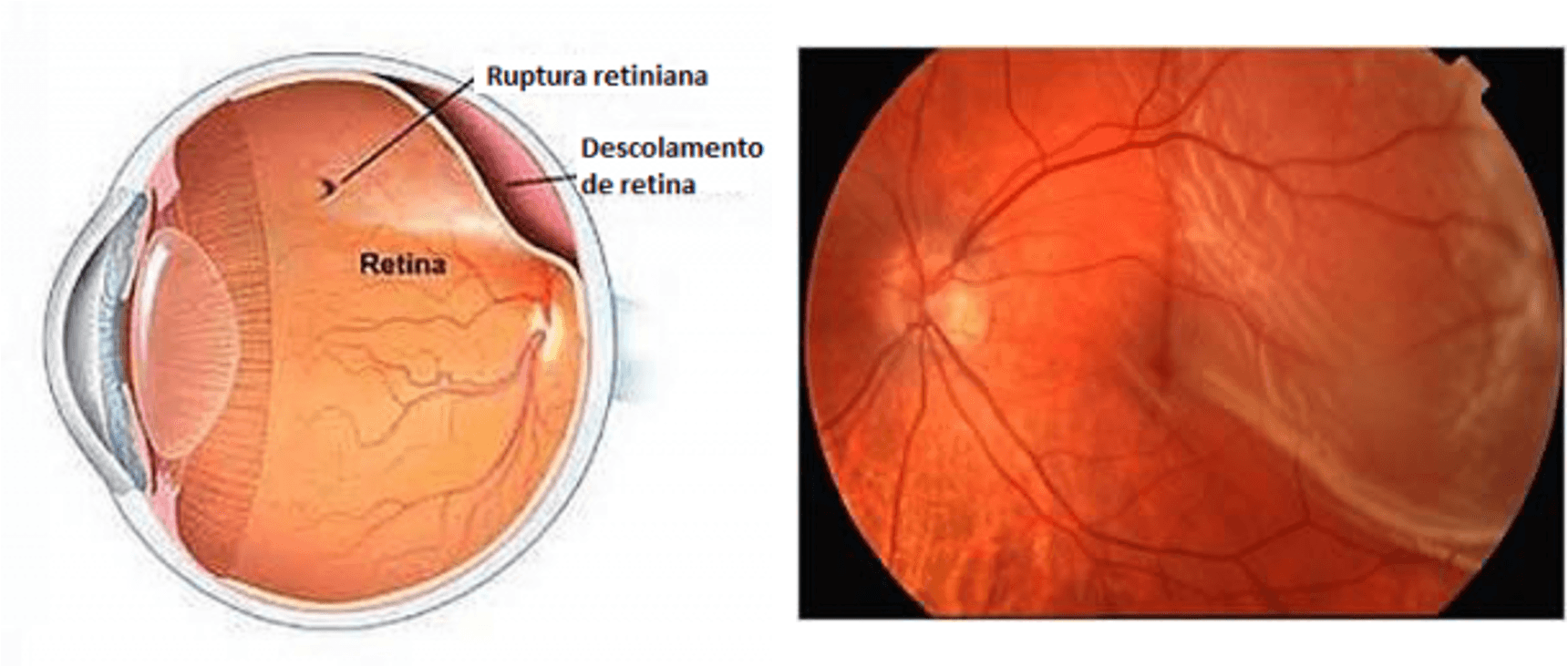 Cirurgia De Retina Vitrectomia Dr Leonardo Eloy Sousa