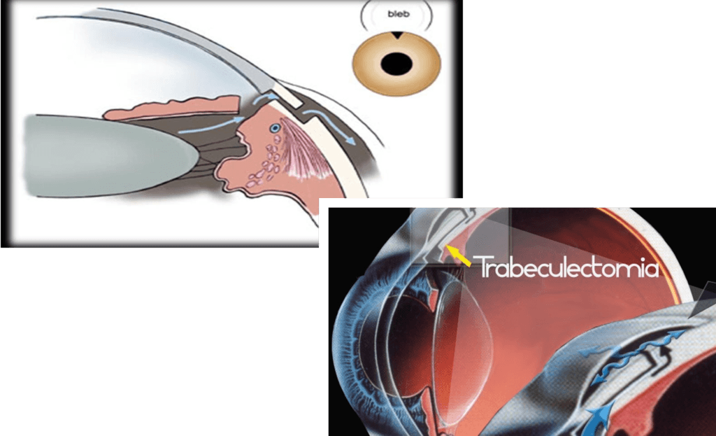 Trabeculectomia |Trec