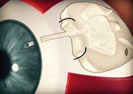 Tubo de Drenagem Glaucoma