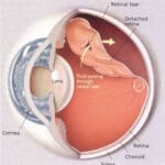 descolamento de retina