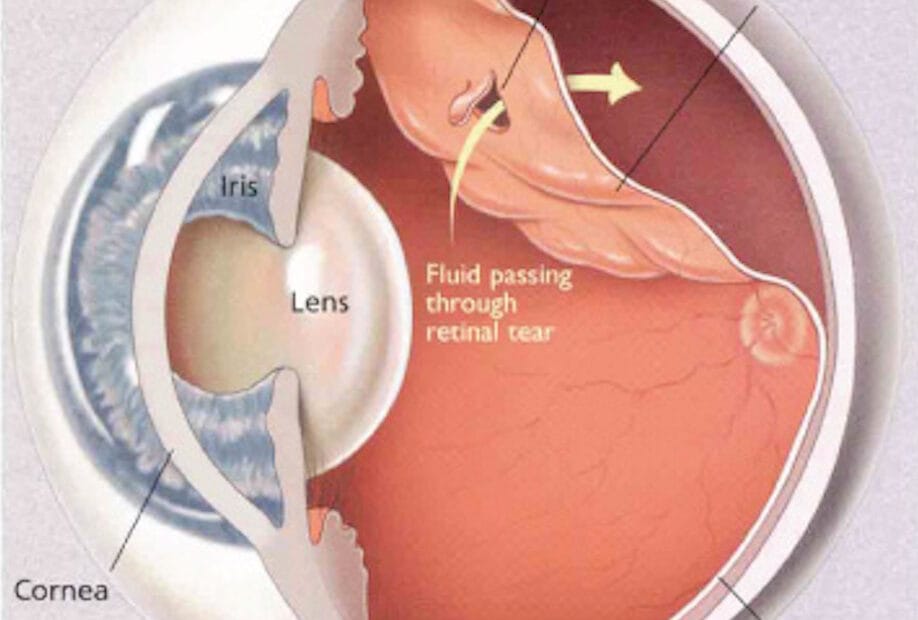 descolamento de retina